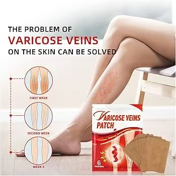 Parche varices